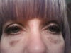 eyes after Juvederm (2 weeks post treatment)