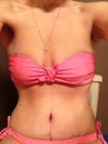 This pic is 6 Wks post op