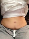 This pic is 11wks 3 days post op