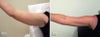 Mesotherapy Before and After Photos