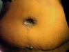 After Tummy Tuck 3-4 weeks out