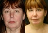 SMAS Facelift Before and After Photos