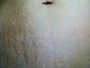 Stretch mark closeup