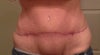 Revised tummy tuck with high scar and high bellybutton