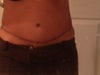 Tummy tuck