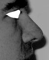Nose Drawn in With Facial Muscles NOTE: Angle at Nostril