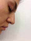 On the 2nd surgery I wanted a shorter nose and the tip lifted and rotated