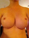 5mths post op