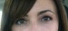 Before I had anything done to eyes- 5 months ago
