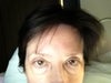 Both eyes still feel very heavy on top/eyelids.