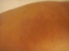 unbearable ichy rash on the back