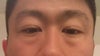 Notice obvious bags protruding under eyes, this was not there 2 weeks ago. Never had it before in my life.