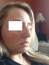 This is the "bad" side where you can see the c-shape deformation I think it's called.