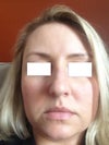 Front view, would straightening it be suffice? Is tip work absolutely necessary?