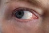 eye showing sunken area under eyes and damage to inner lower rim