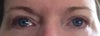 eyes showing sunken outer corners