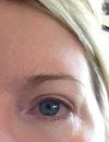 right eye showing sunken outer corner