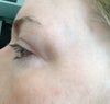 sunken outer corner of eye