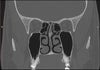 Nose Ct Scan