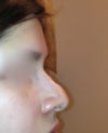 angle shot of right side, as you can see there is a lump but I'm not sure if it is scar tissue or what?