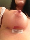 the lighter bruise on the left side of the incision appeared today. The bruise around incision has been there