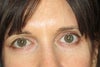 eye on left (my right eye) had surgery