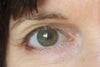 eye with surgery