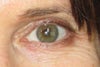 eye without surgery