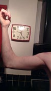 Inner arm was not burned as the rest but has smoothed out from skin grafts and time.