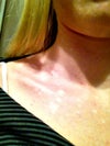 This is my chest. I actually started getting spots on my chest about 15-16 years ago.