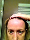 I also have hypopigmentation on both of cheekbones.