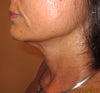 I had facelift in 96.  However, now marionette line on both sides and downturn corners of mouth make me look sad and also turkey neck.   Plan to have  lower facelift but then told that thermage and/or botox, pelleve would address this