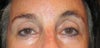 Shows some problems after droopy eye was corrected in 1996. Upper is only a problem when I put shadow on  but I see the eyes aren't really symetrical but then neither is my mouth.