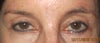 Had permanent eyeliner done in 92 and this is day before retouched 12-11-12 and now I'm worried that a blepharoplasty will cut off the new permanent liner underneath?