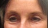 This seems to have only developed over the last few months.  Not sure if the microcurrent treatments combined with facials had anything to do with this or maybe I'm just stressed and tired?     Will thermage, botox, or fractional laser treatment really fix the bags under the eyes?   I had some laser Radio Frequency to build collegen around my mouth but no noticable result that I can see.  I feel many of those procedures are not permanent.  Want artfill & silikon 1000.