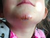 stitches in the chin