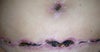 Full tummy tuck scar 5 weeks post op