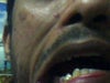 Denture on Right 1 premolar.