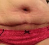 tummy tuck scar 6 months post op