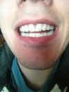 As you can see my top teeth slant and my bottom have gone to there normal state prior braces.