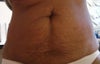 excess belly skin
