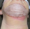 The skin on my neck has always been sensitive. I iced it the first 2 days. Could it be freezer burn?