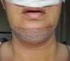 The skin under the bandage feels itchy as well but I haven't noticed any pus or smelled anything because I am recovering from rhinoplasty as well.