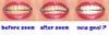 The first 2 pics taken the morning right before and right after the Zoom, the third one is edited in Photoshop to demonstrate the possible dramatic color change in 12 teeth only