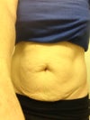 This is where my belly is now!! I have tried for 3 years now to get it down. Before my injury i had some abs showing but the bubble in the middle and the drop at the bottom from my c section never goes away.