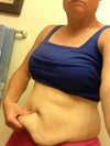 Why I so bad want it gone. I am in to nutritonal counseling and personal training and to do a push up and have all the skin just hang down, really bugs me.