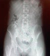 The unlevel hip bone. Was measured at .25 of an inch.