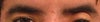 My left eyelid is larger and closer to my eyebrows, which are also uneven.