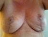 Two weeks post up - left showing sagging.