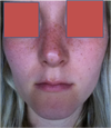 My nose looks a little crooked on one side above the tip, but feels soft there, like it is swelling... is that possible? Thanks :) :)